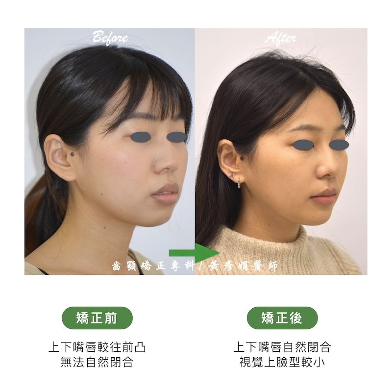台中患者暴牙矯正前後的臉型外觀比較:矯正前上下嘴唇較往前凸;矯正後上下嘴唇自然閉合,視覺上臉型變小
