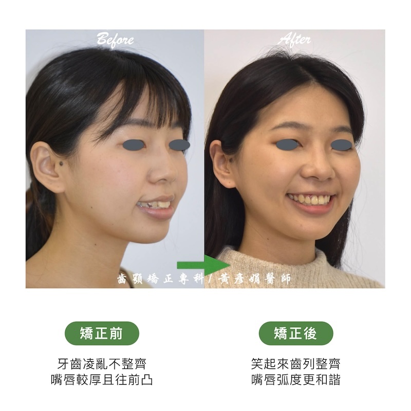 台中患者暴牙矯正前後的臉型外觀比較:矯正前牙齒亂、嘴唇較厚往前凸;矯正後齒列整齊,嘴唇弧度更和諧